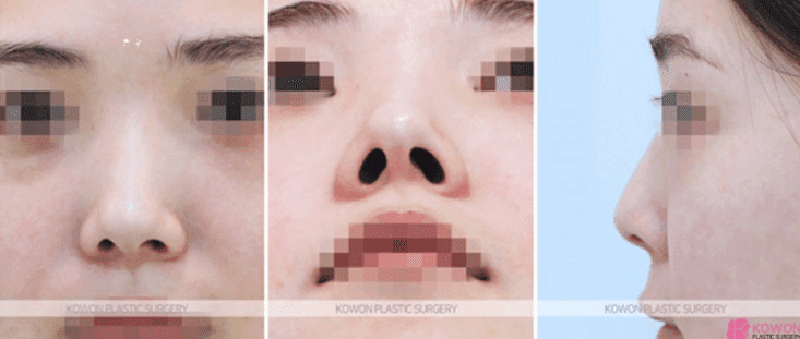 การผ่าตัดจมูกเชิด: คุณสามารถเปลี่ยนความยาวและรูจมูกได้โดยไม่ต้องใช้อิมแพลนต์เสริมหรือไม่? — สรุปเนื้อหาและวิธีการ ภาพประกอบ 4/10