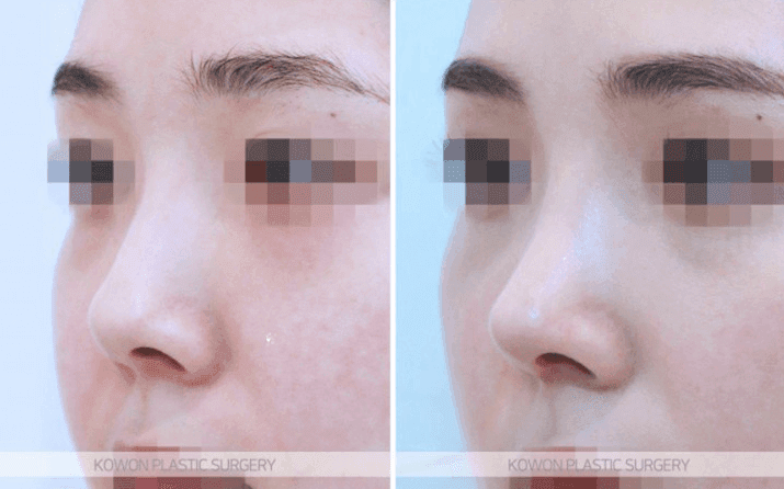 การผ่าตัดจมูกเชิด: คุณสามารถเปลี่ยนความยาวและรูจมูกได้โดยไม่ต้องใช้อิมแพลนต์เสริมหรือไม่? — สรุปเนื้อหาและวิธีการ ภาพประกอบ 5/10