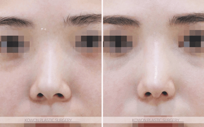 การผ่าตัดจมูกเชิด: คุณสามารถเปลี่ยนความยาวและรูจมูกได้โดยไม่ต้องใช้อิมแพลนต์เสริมหรือไม่? — สรุปเนื้อหาและวิธีการ ภาพประกอบ 6/10