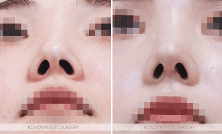 การผ่าตัดจมูกเชิด: คุณสามารถเปลี่ยนความยาวและรูจมูกได้โดยไม่ต้องใช้อิมแพลนต์เสริมหรือไม่? — สรุปเนื้อหาและวิธีการ ภาพประกอบ 7/10