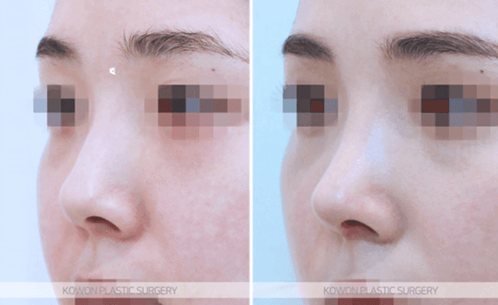 การผ่าตัดจมูกเชิด: คุณสามารถเปลี่ยนความยาวและรูจมูกได้โดยไม่ต้องใช้อิมแพลนต์เสริมหรือไม่? — สรุปเนื้อหาและวิธีการ ภาพประกอบ 8/10