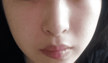 들린코 수술 후 화살코가 됐다면 — 비주 위치·콧등·코끝을 나눠 보는 재수술 기준 관련 이미지 3/7