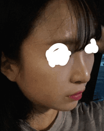 들린코 수술 후 화살코가 됐다면 — 비주 위치·콧등·코끝을 나눠 보는 재수술 기준 관련 이미지 4/7