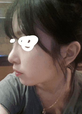 들린코 수술 후 화살코가 됐다면 — 비주 위치·콧등·코끝을 나눠 보는 재수술 기준 관련 이미지 5/7