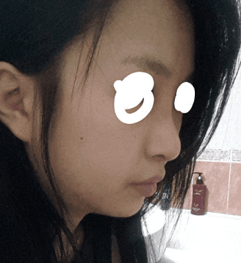 들린코 수술 후 화살코가 됐다면 — 비주 위치·콧등·코끝을 나눠 보는 재수술 기준 관련 이미지 6/7