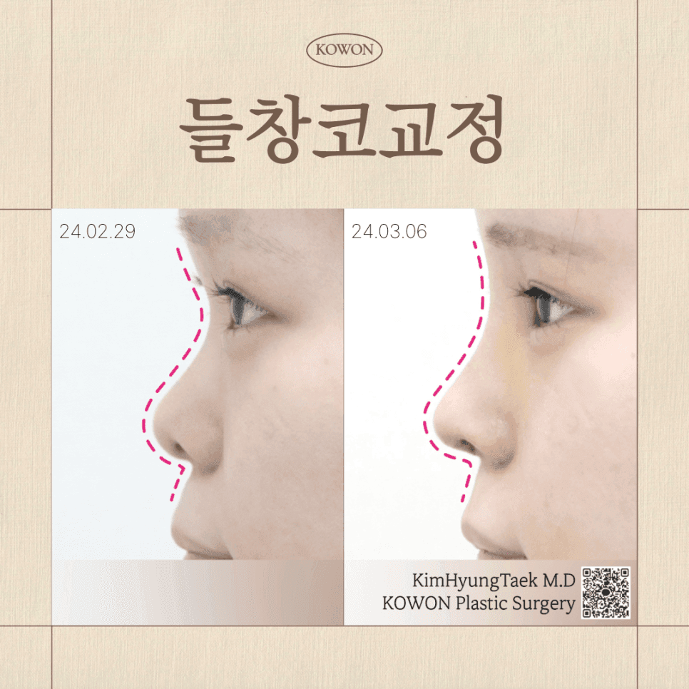 การแก้ไขจมูกเชิดสาเหตุของปลายจมูกเชิด และเกณฑ์ในการพิจารณาใช้กระดูกอ่อนซี่โครงของตนเองภาพประกอบ 1/9