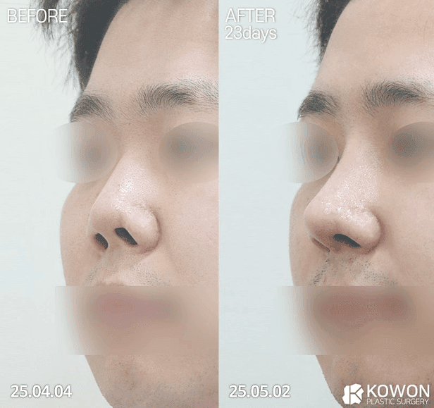 들창코수술 전 확인해야 할 것들 — 코끝만 내리면 안 되는 이유와 자가늑연골을 쓰는 경우 관련 이미지 3/7
