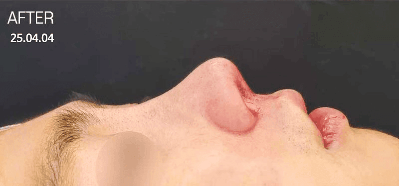 들창코수술 전 확인해야 할 것들 — 코끝만 내리면 안 되는 이유와 자가늑연골을 쓰는 경우 관련 이미지 5/7