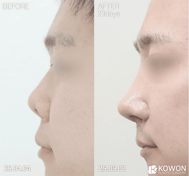 들창코수술 전 확인해야 할 것들 — 코끝만 내리면 안 되는 이유와 자가늑연골을 쓰는 경우 관련 이미지 6/7