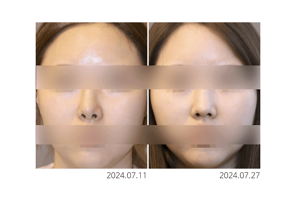 코끝재수술, 들린코가 됐다면 무엇부터 확인해야 하나요 — 비순각과 비주 지지 구조 관련 이미지 2/5