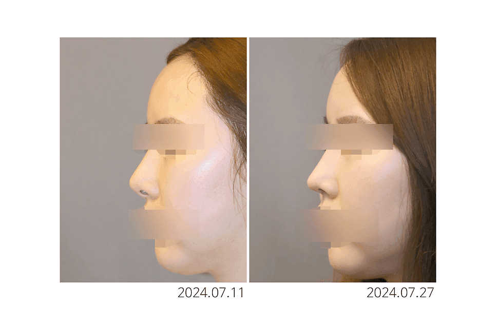코끝재수술, 들린코가 됐다면 무엇부터 확인해야 하나요 — 비순각과 비주 지지 구조 관련 이미지 3/5