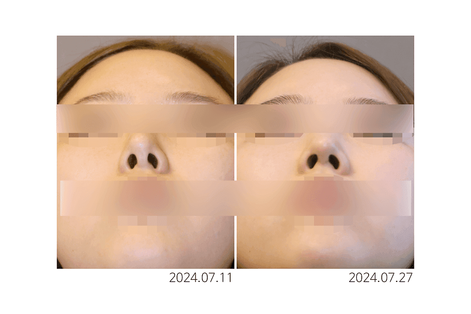 코끝재수술, 들린코가 됐다면 무엇부터 확인해야 하나요 — 비순각과 비주 지지 구조 관련 이미지 4/5