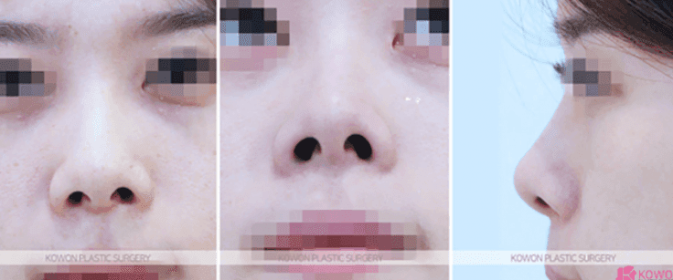 양악수술 후 들창코 교정, 비중격연골이 부족하면 무엇으로 보완하나요 관련 이미지 3/9