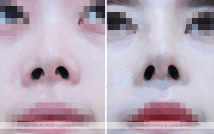 양악수술 후 들창코 교정, 비중격연골이 부족하면 무엇으로 보완하나요 관련 이미지 7/9