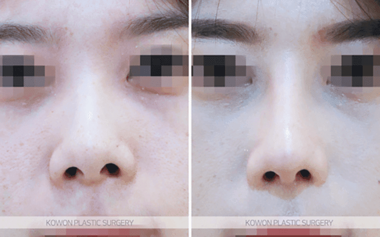 양악수술 후 들창코 교정, 비중격연골이 부족하면 무엇으로 보완하나요 관련 이미지 8/9