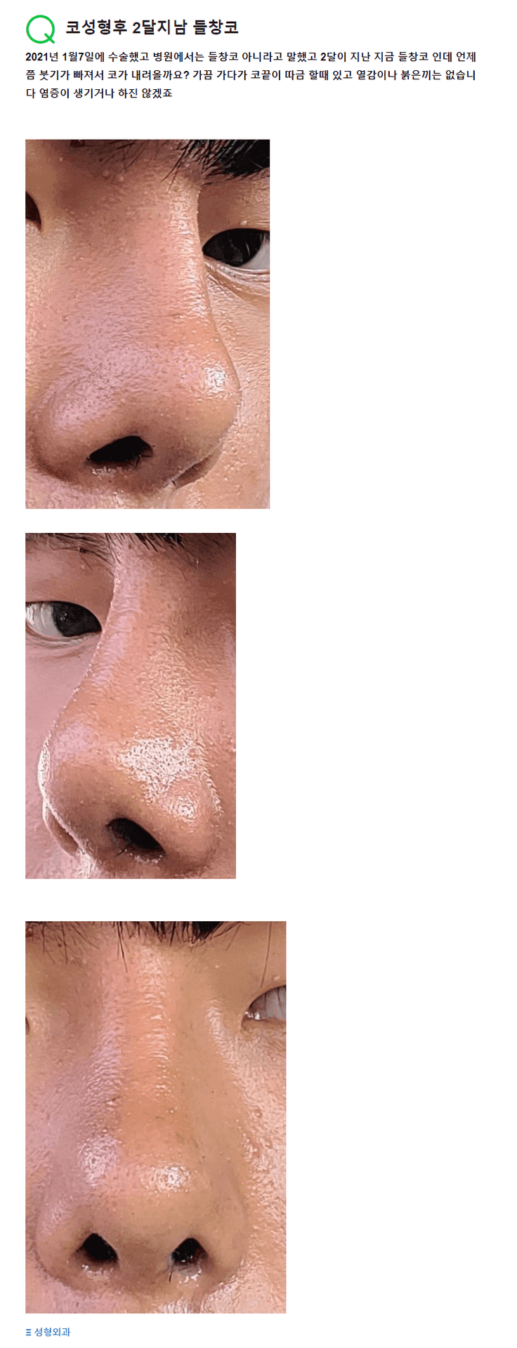 코성형 2개월 뒤 들창코가 됐어요 — 더 내려오기를 기다려도 될까 관련 이미지 2/2
