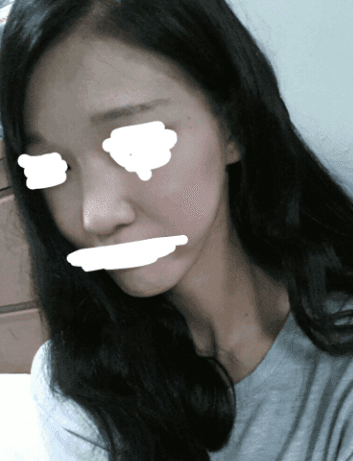 넓은 콧등뼈 절골술, 긴 얼굴이 더 길어 보일까 — 폭과 길이의 관계 관련 이미지 4/4