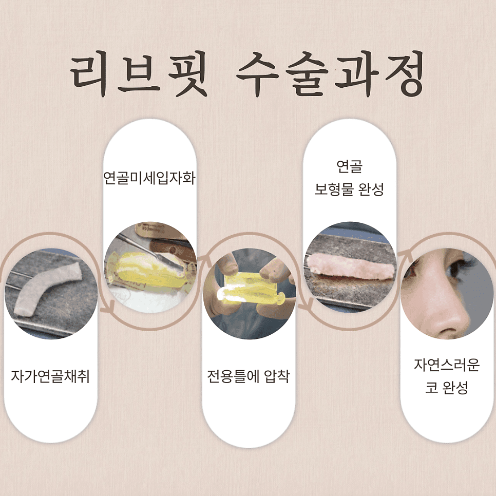 การลดขอบรูจมูกลงกับจมูกเชิด (ยงโค) แตกต่างกันอย่างไร และใช้เกณฑ์อะไรในการตัดสิน? ภาพที่เกี่ยวข้อง 4/6