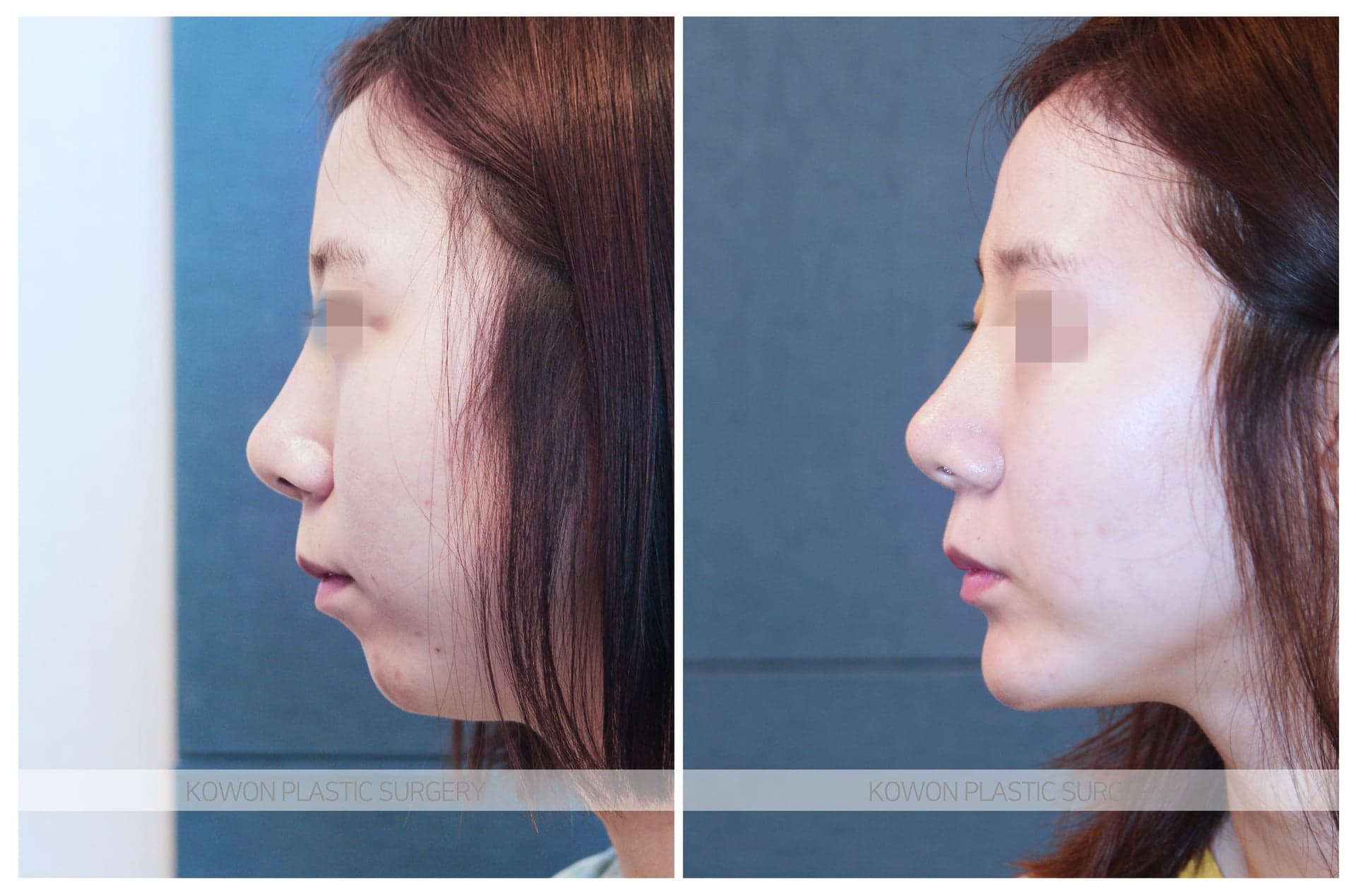무턱보형물 수술 전 사진 — 로그인 후 열람