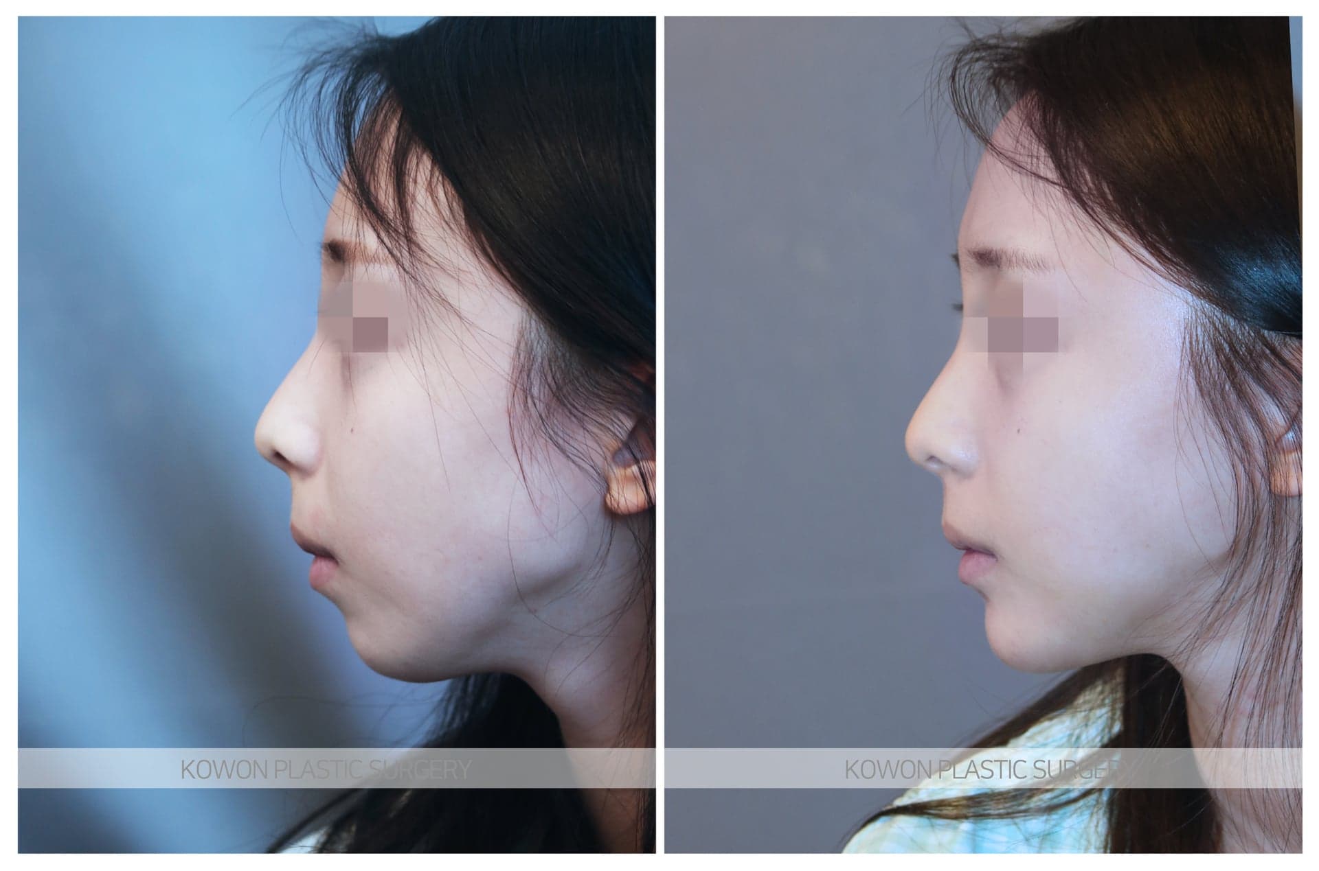 무턱보형물 수술 전 사진 — 로그인 후 열람