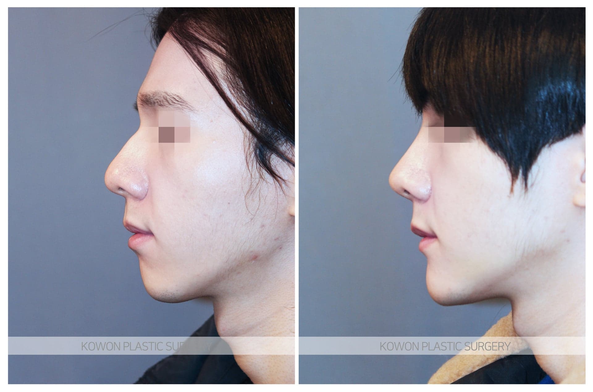 무턱보형물 수술 전 사진 — 로그인 후 열람