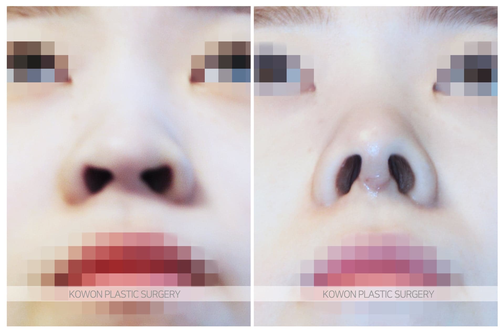 낮은코_콧볼이 넓은 코 수술 전 사진 — 로그인 후 열람