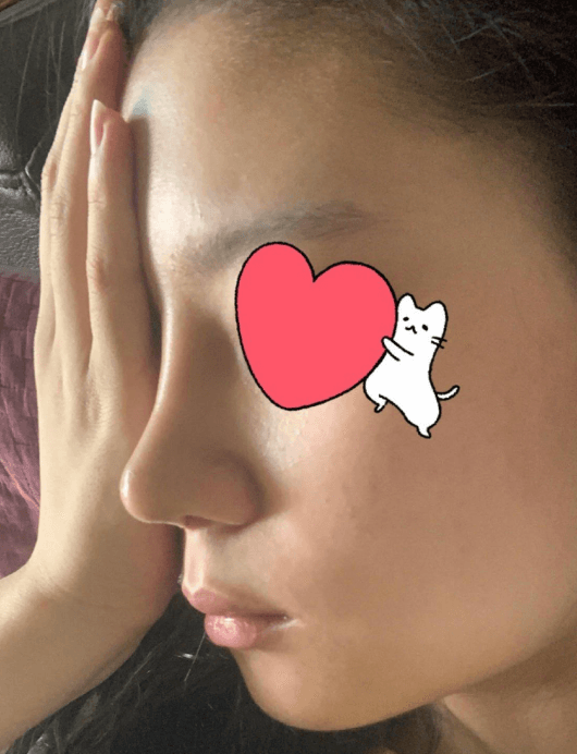 이정도면 얄상하게 잘나온거같지않나요?? 수술후기 사진 2