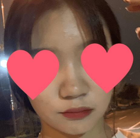 이정도면 얄상하게 잘나온거같지않나요?? 수술후기 사진 3