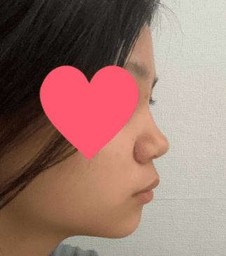 이정도면 얄상하게 잘나온거같지않나요?? 수술후기 사진 4