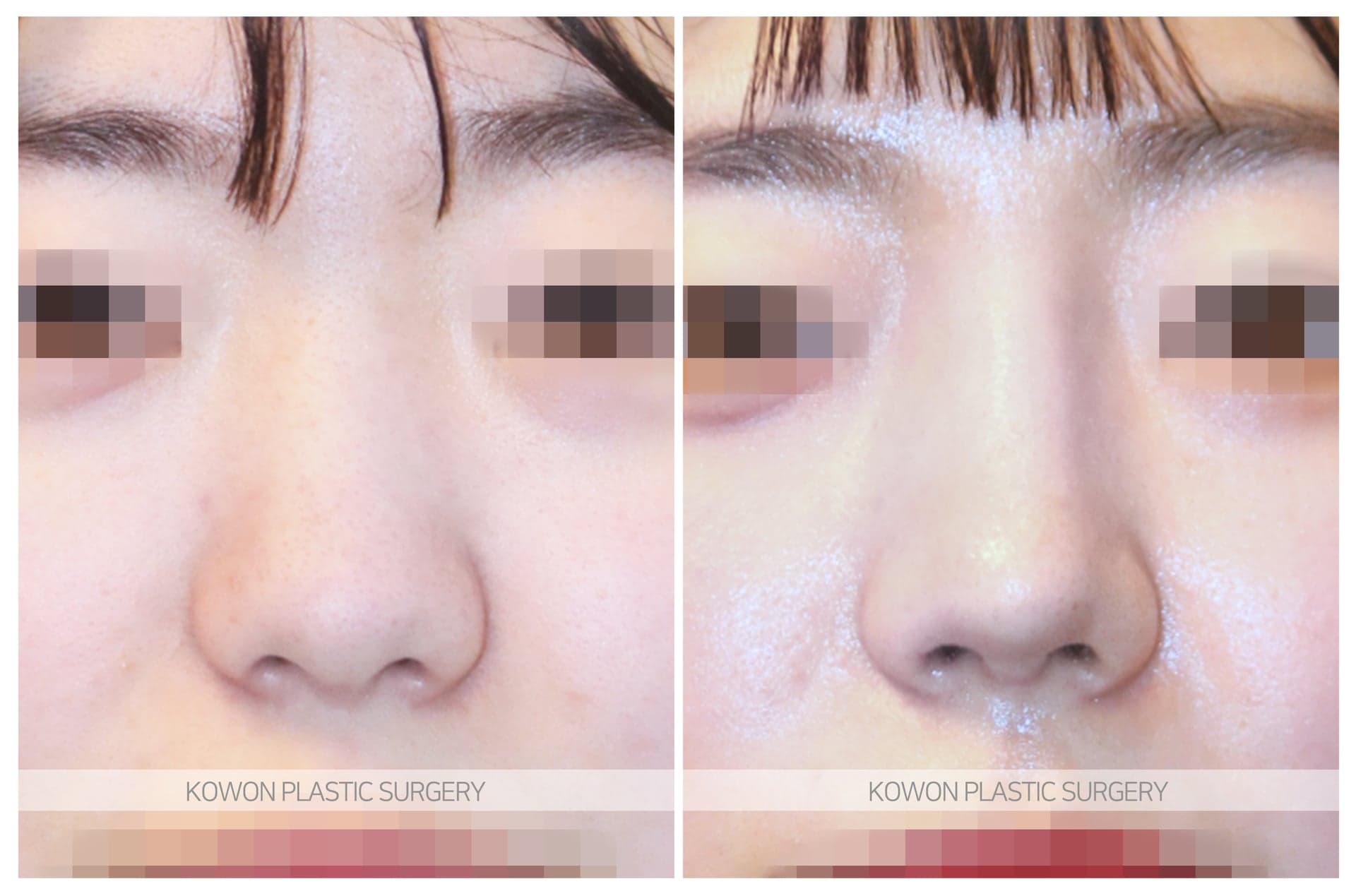 들창코_코끝이 뭉툭한 코 수술 전 사진 — 로그인 후 열람