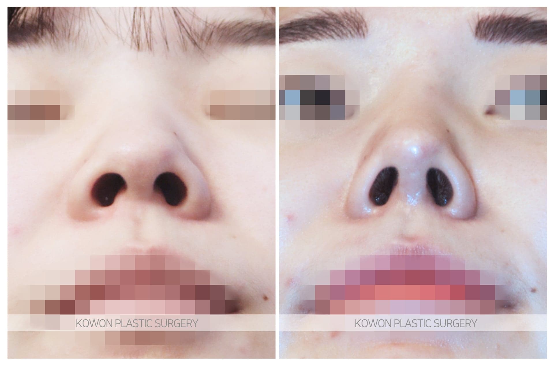 짧은코_코끝이 내려간 코 수술 전 사진 — 로그인 후 열람
