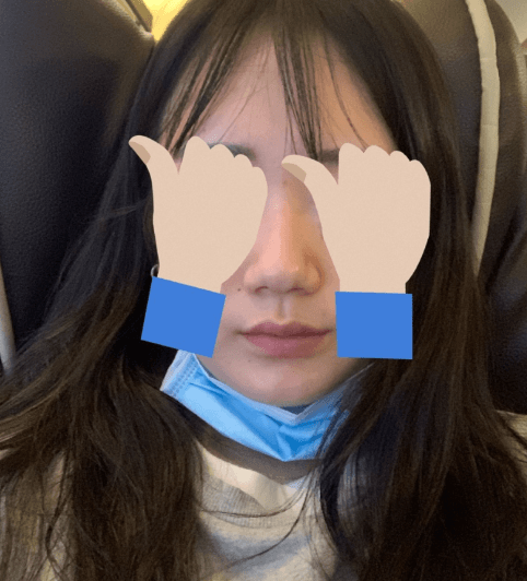 코로 인생역전 수술후기 사진 4