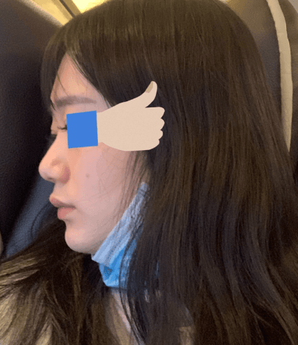 코로 인생역전 수술후기 사진 5