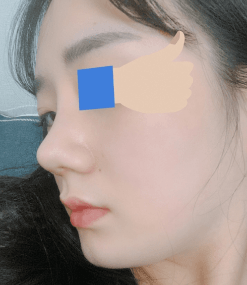 코로 인생역전 수술후기 사진 3