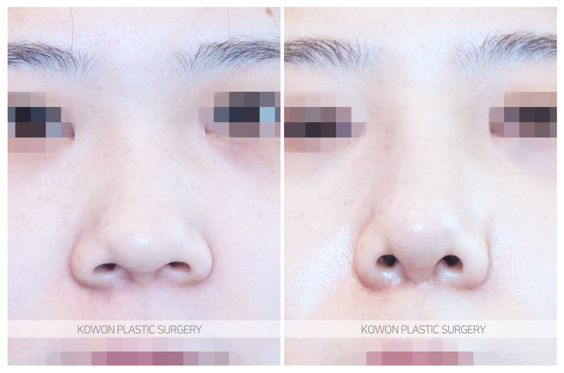 복코_콧날개가 넓은코/낮은코 수술 전 사진 — 로그인 후 열람