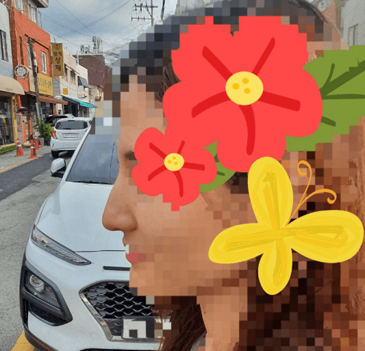 수술 너무 만족합니다! 수술후기 사진 4