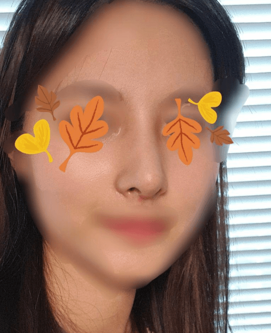 수술 너무 만족합니다! 수술후기 사진 2
