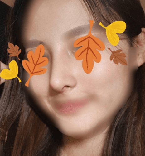 수술 너무 만족합니다! 수술후기 사진 3