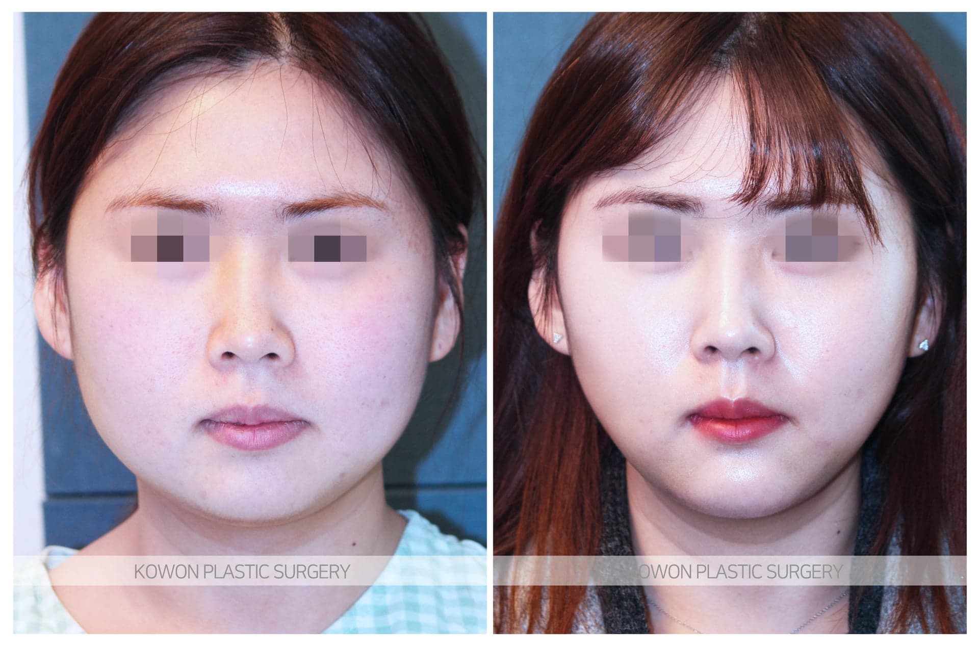 코원성형외과_무턱수술 수술 전 사진 — 로그인 후 열람