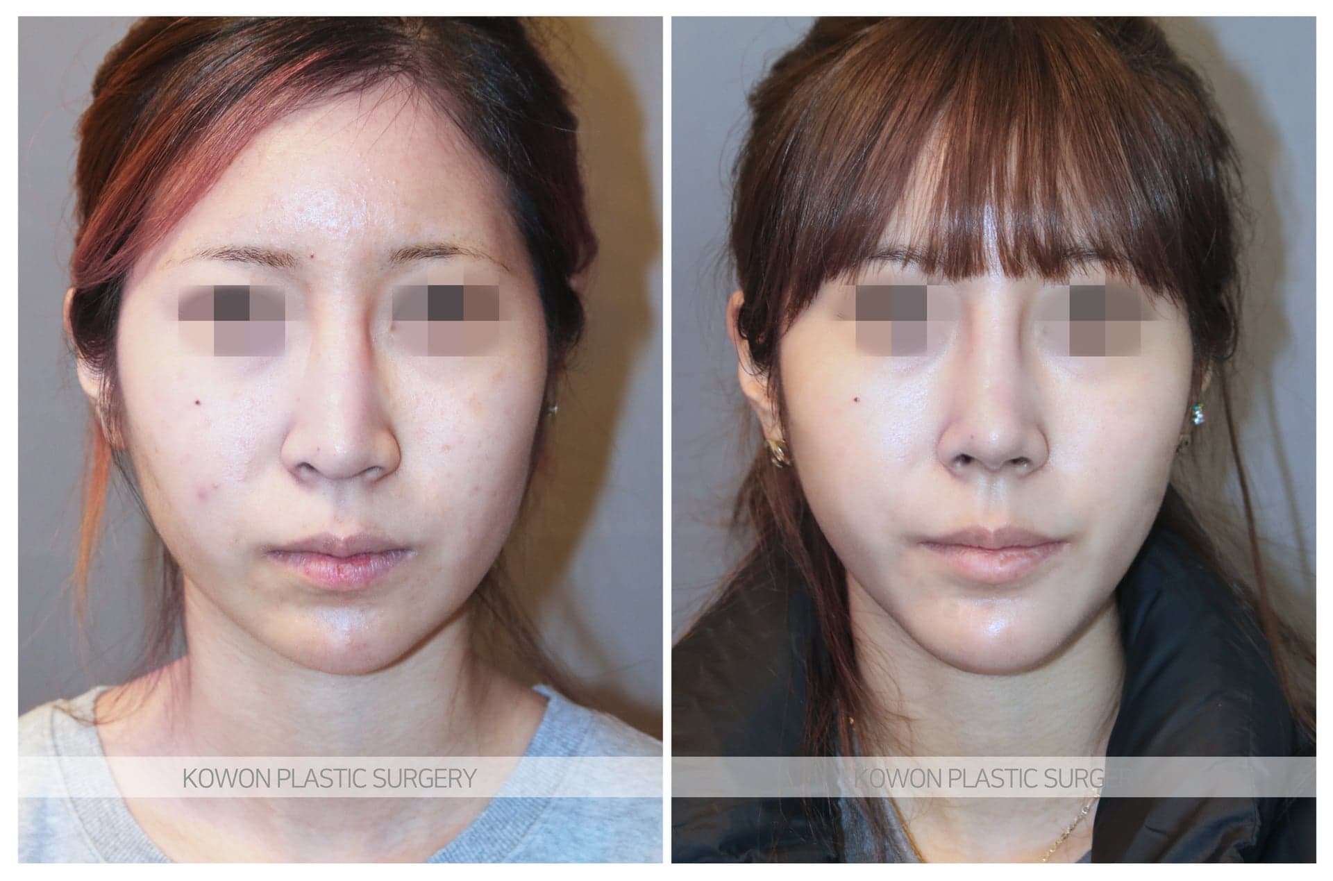 코원성형외과_무턱수술 수술 전 사진 — 로그인 후 열람