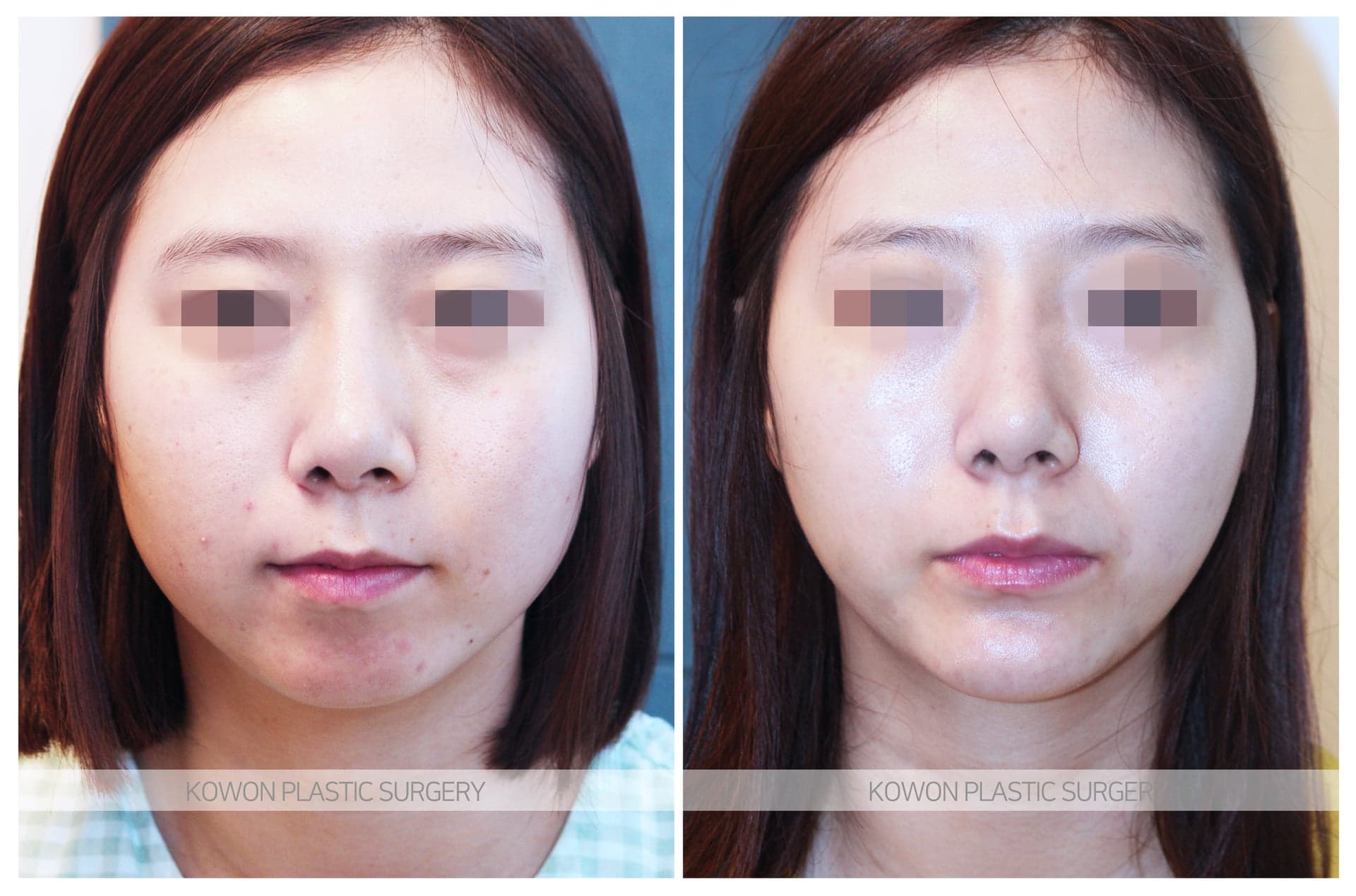 코원성형외과_무턱수술 수술 전 사진 — 로그인 후 열람
