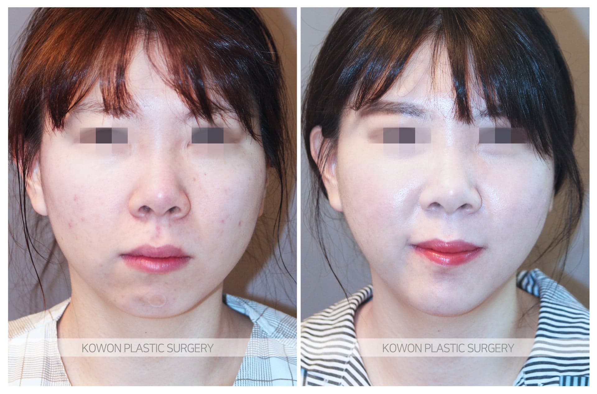 코원성형외과_무턱수술 수술 전 사진 — 로그인 후 열람