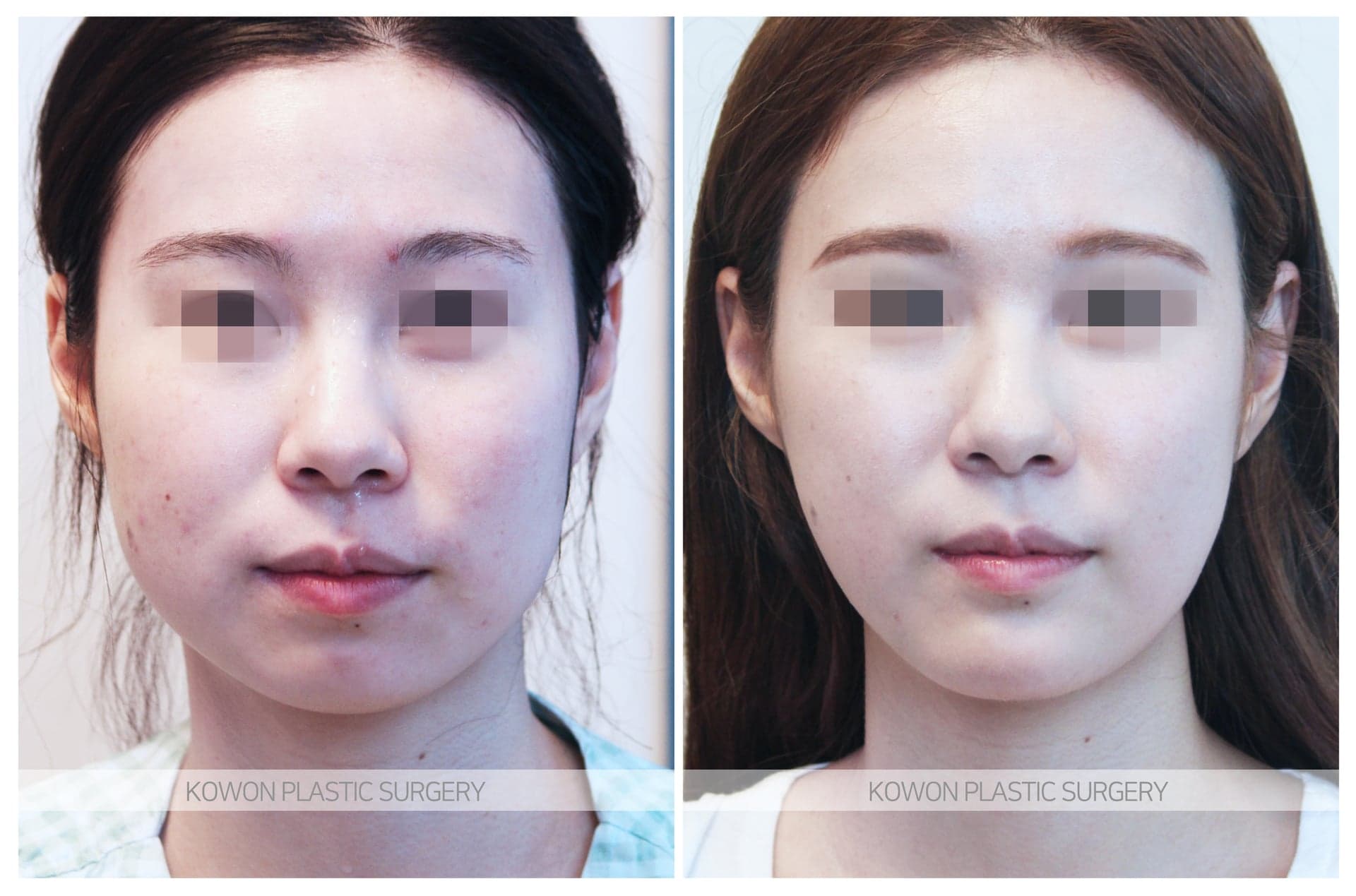 코원성형외과_무턱수술 수술 전 사진 — 로그인 후 열람