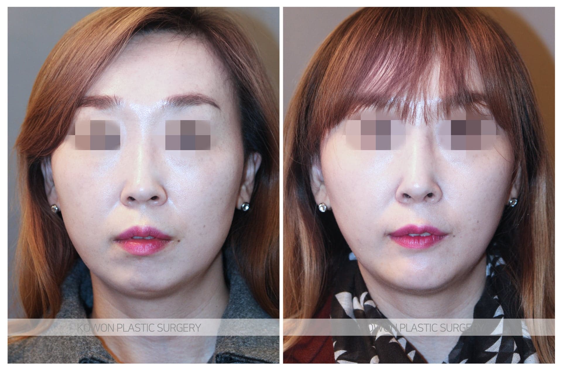 코원성형외과_무턱수술 수술 전 사진 — 로그인 후 열람