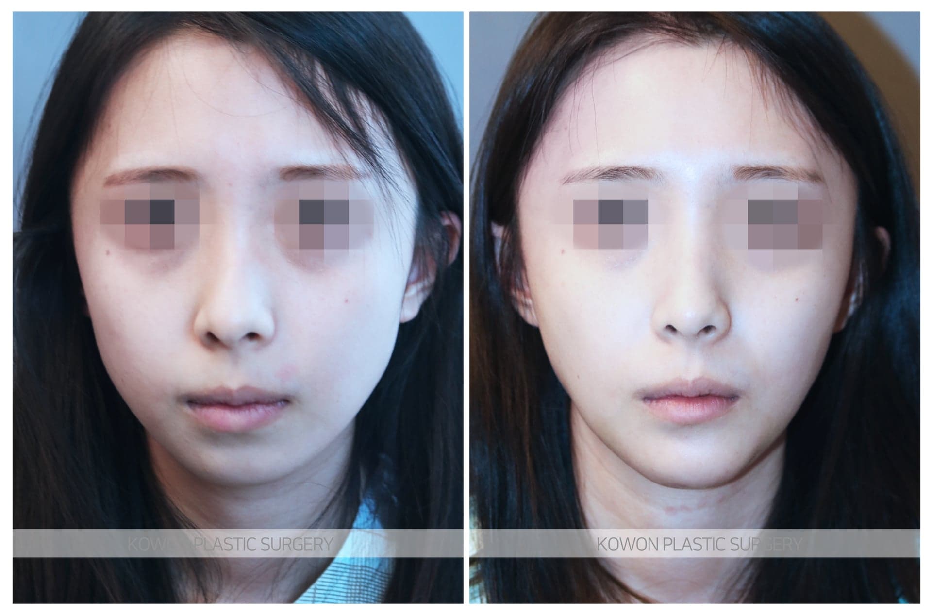 코원성형외과_무턱수술 수술 전 사진 — 로그인 후 열람