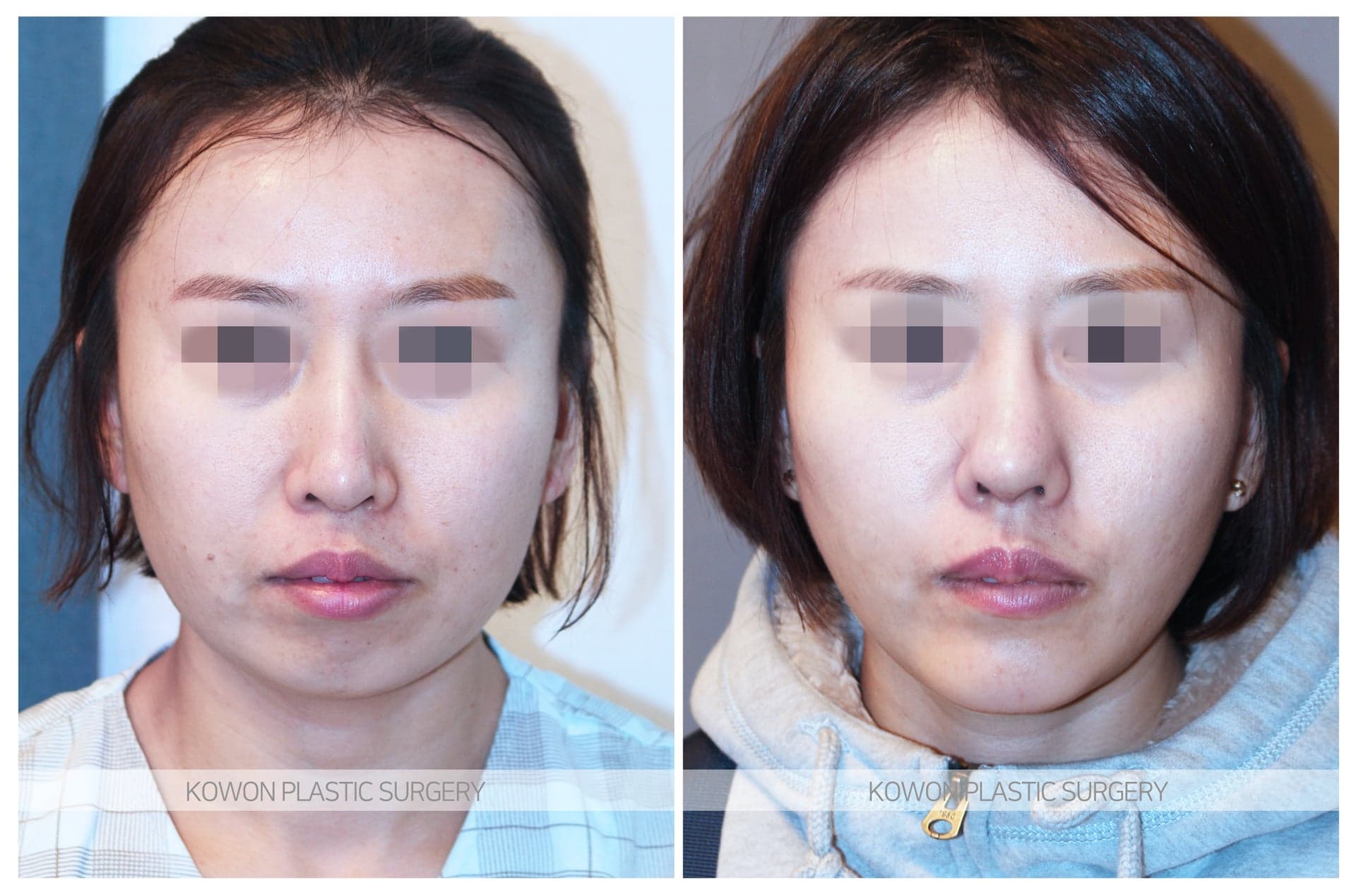 코원성형외과_무턱수술 수술 전 사진 — 로그인 후 열람