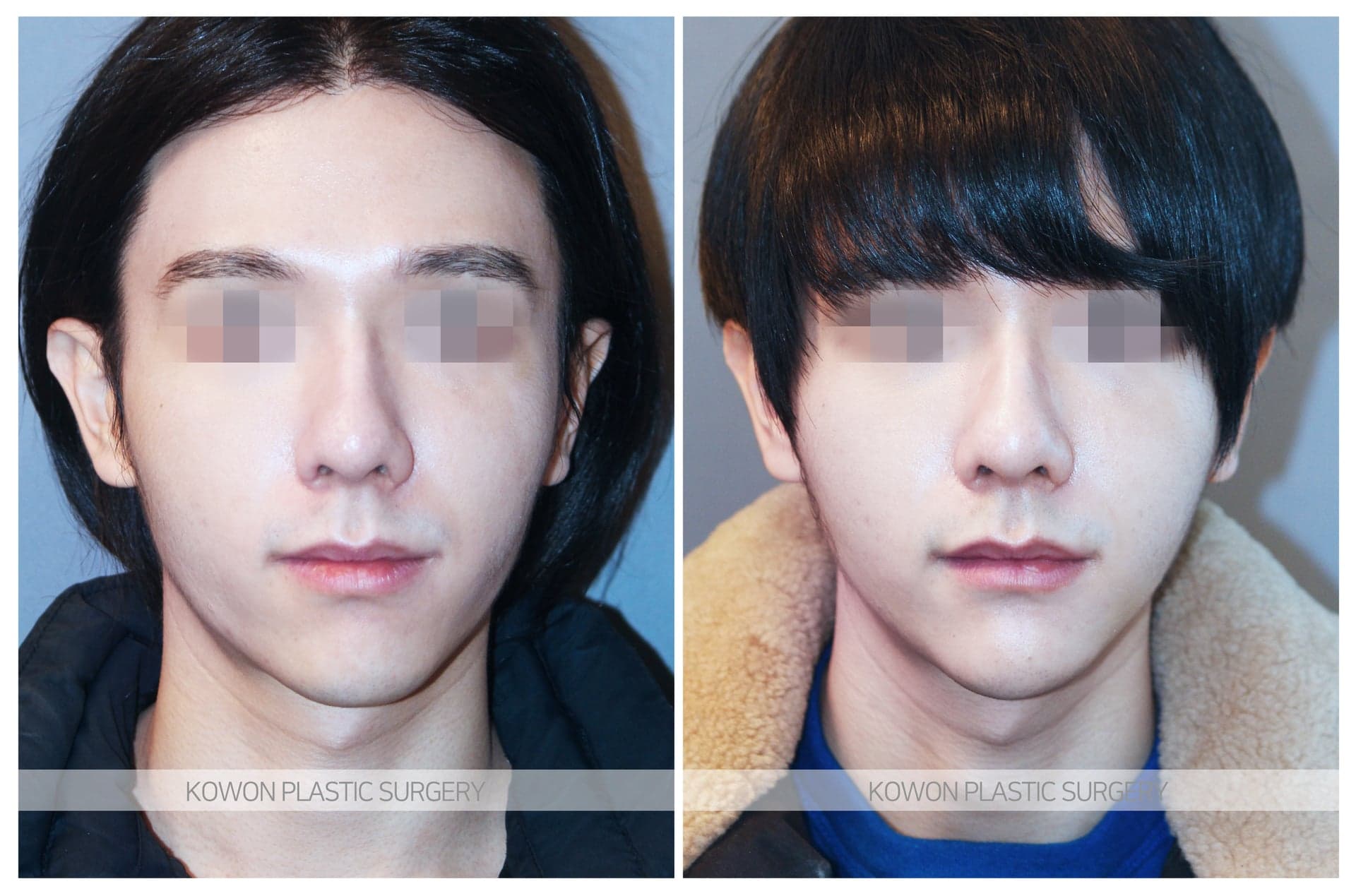 코원성형외과_무턱수술 수술 전 사진 — 로그인 후 열람