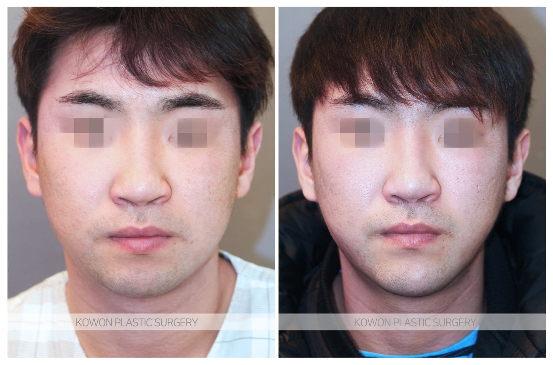 코원성형외과_무턱수술 수술 전 사진 — 로그인 후 열람