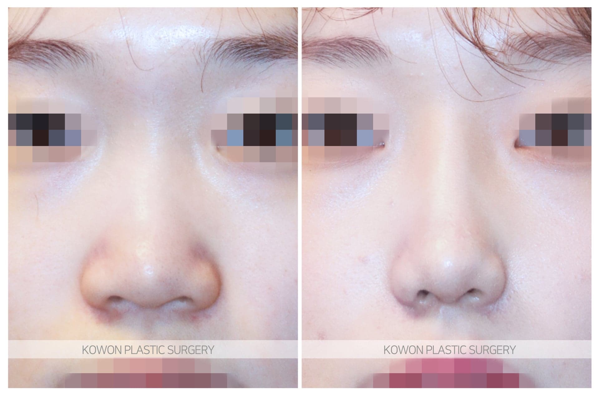 복코_낮은코/짧은코 수술 전 사진 — 로그인 후 열람
