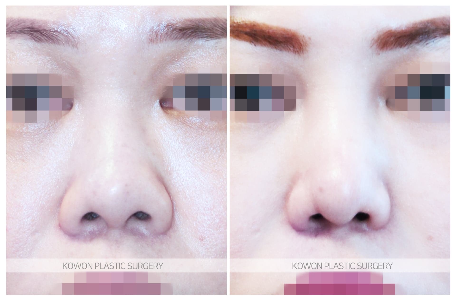 복코_코에 살이 많은코/두꺼운코/들창코 수술 전 사진 — 로그인 후 열람